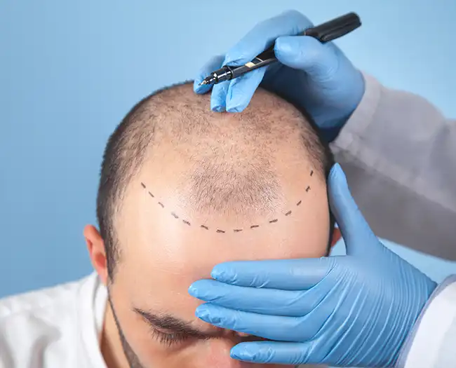 Fue Hair Transplant