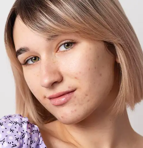 Aftercare Required after Acne Scar Reduction Treatment