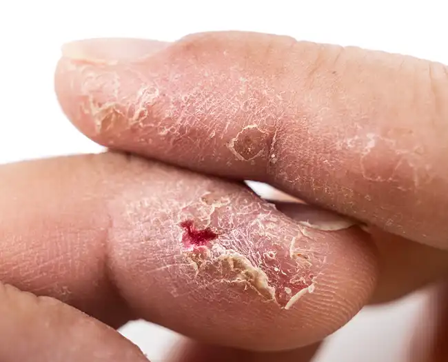 Infections