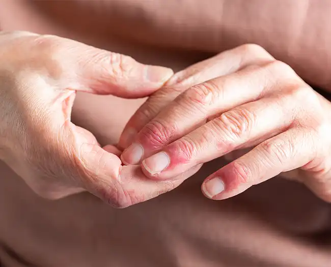 Skin Allergy