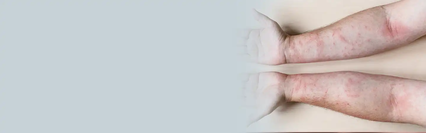 Psoriasis Treatment