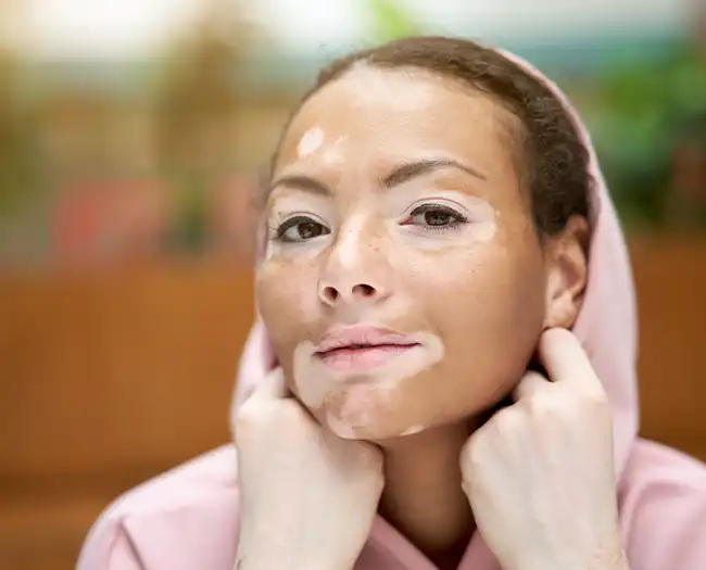 Vitiligo