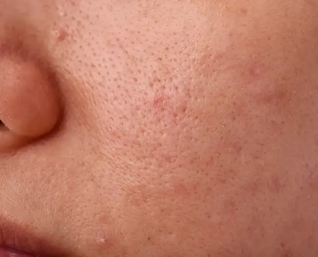 Open Pores Treatment