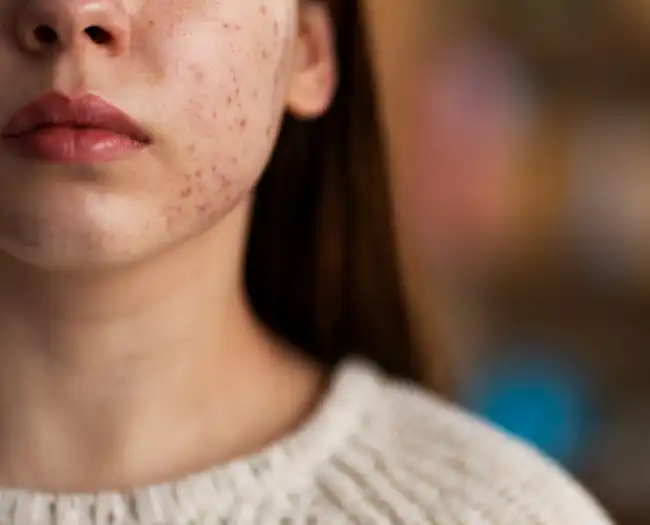 Acne Treatment