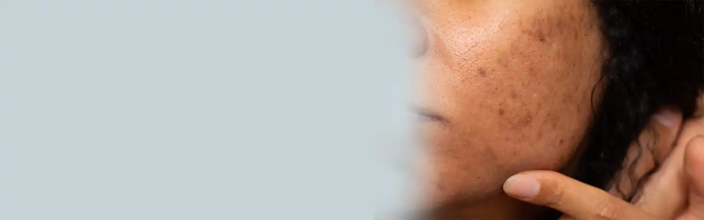 Dark Spot