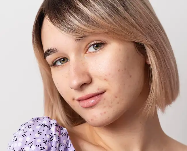 Acne Scars