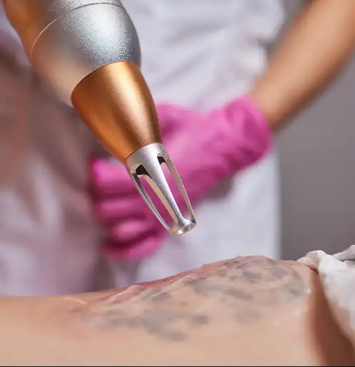 Laser Tattoo Removal Procedure