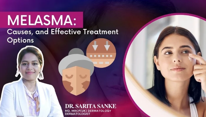 Melasma: Causes, and Effective Treatment Options by Dr. Sarita Sanke