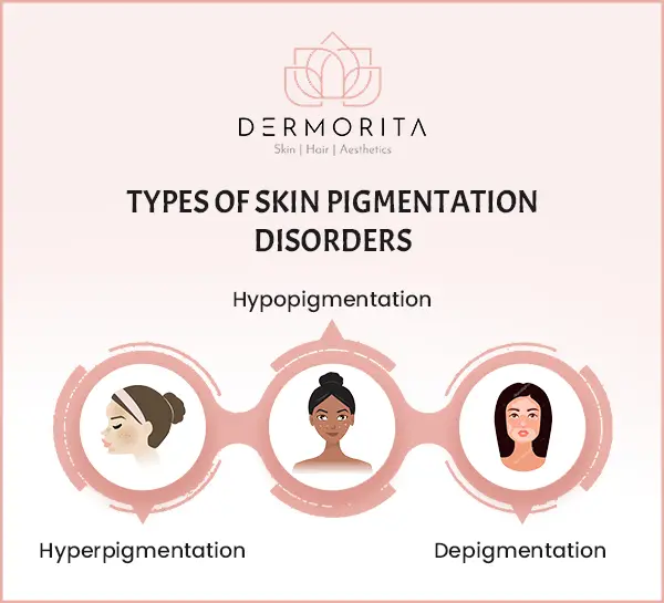 Types of Skin Pigmentation Disorders